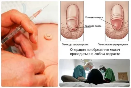 Лікування тріщин на крайньої плоті у чоловіків