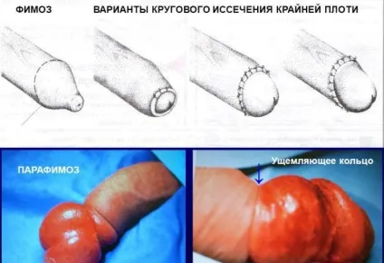 Лікування тріщин на крайньої плоті у чоловіків