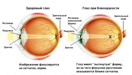 Короткозорість причини, симптоми, лікування, народні засоби (кошти) Короткозорість причини, симптоми, лікування, народні засоби