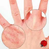 Висип на кистях рук (поява) Висип на кистях рук