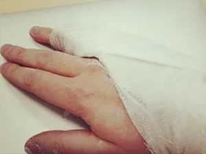 Симптоми і ознаки перелом мізинця на руці лікування і реабілітація
