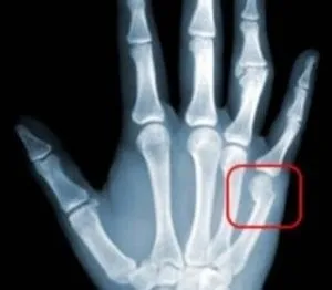 Симптоми і ознаки перелом мізинця на руці лікування і реабілітація