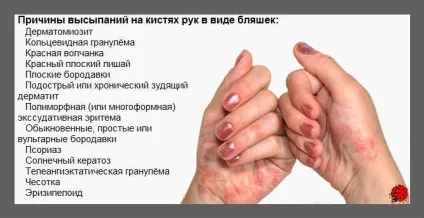 Висип на кистях рук (причина) Висип на кистях рук