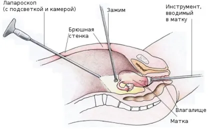 Симптоми і підходи до лікування пельвіоперітоніта різних типів