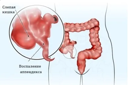 Симптоми і підходи до лікування пельвіоперітоніта різних типів