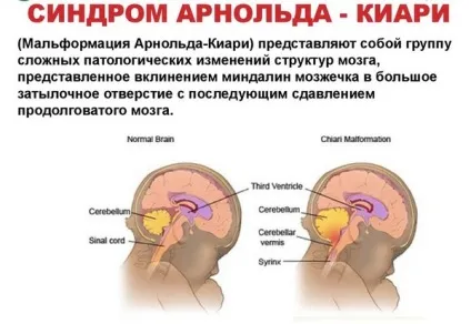 Синдром Арнольда Кіарі аномалія 1 типу, мальформация, тривалість життя