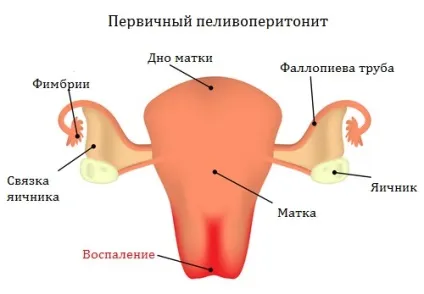 Симптоми і підходи до лікування пельвіоперітоніта різних типів