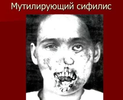 Сифіліс на обличчі - фото поразки особи сифілісом (особі) Сифіліс на обличчі - фото поразки особи сифілісом