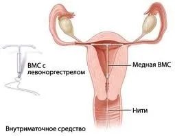 Скільки років можна ходити зі спіраллю
