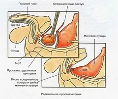 Способи оперативного лікування аденоми передміхурової залози (лікування) Способи оперативного лікування аденоми передміхурової залози