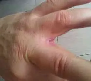 Сохне шкіра між пальцями рук - захворювання шкіри - каталог статей - народні лікарські рецепти (пальцями) Сохне шкіра між пальцями рук - захворювання шкіри - каталог статей - народні лікарські рецепти