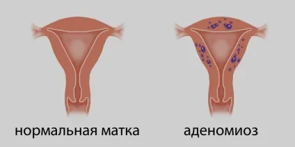 Спайки в малому тазу симптоми лікування (симптоми) Спайки в малому тазу симптоми лікування