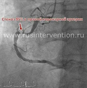 Стентування коронарних артерій - український кардіологічний науково-виробничий копмлекс (стентування коронарних артерій) Стентування коронарних артерій - український кардіологічний науково-виробничий копмлекс