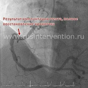 Стентування коронарних артерій - український кардіологічний науково-виробничий копмлекс (стентування коронарних артерій) Стентування коронарних артерій - український кардіологічний науково-виробничий копмлекс