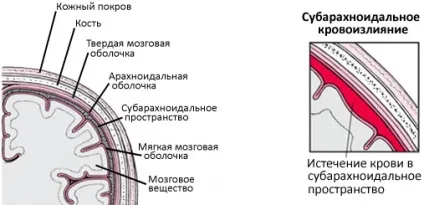 Субарахноїдальний крововилив лікування, причини, наслідки (наслідки) Субарахноїдальний крововилив лікування, причини, наслідки