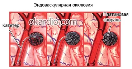 Субарахноїдальний крововилив що це, причини, лікування, наслідки