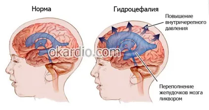 Субарахноїдальний крововилив що це, причини, лікування, наслідки