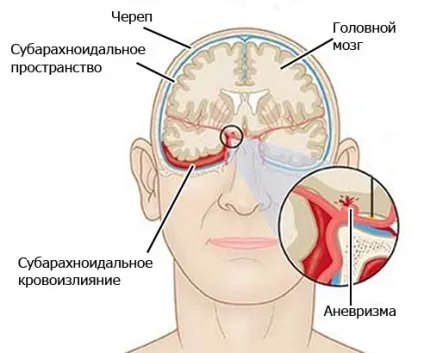 Субарахноїдальний крововилив що це, причини, лікування, наслідки