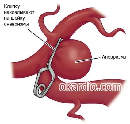 Субарахноїдальний крововилив що це, причини, лікування, наслідки