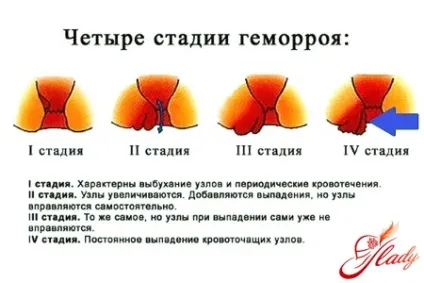 Свічки для лікування геморою у жінок (які існують свічки) Свічки для лікування геморою у жінок