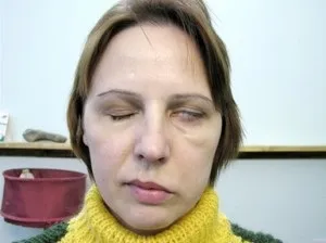 Ботулізм від чого буває, причини виникнення, профілактика (чого) Ботулізм від чого буває, причини виникнення, профілактика