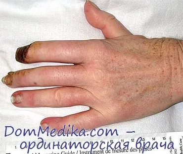 Хвороба рено (трофоневроза)