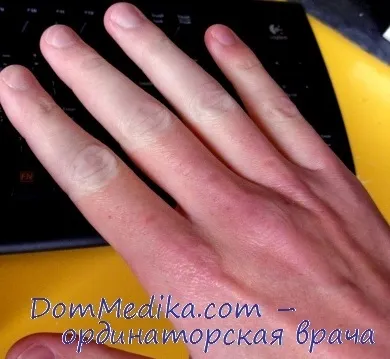 Хвороба рено (трофоневроза)