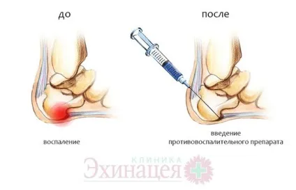 Болить п'ята до якого лікаря звертатися лікування болю і симптоми хвороби на eurolab, розгардіяш і (болить) Болить п'ята до якого лікаря звертатися лікування болю і симптоми хвороби на eurolab, розгардіяш і