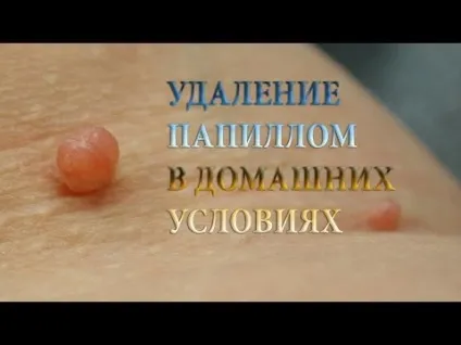 Бородавка на п'яті (п'яткова) як позбутися і чим лікувати в домашніх умовах (п'яткова) Бородавка на п'яті (п'яткова) як позбутися і чим лікувати в домашніх умовах