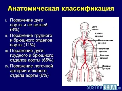 Хвороба Такаясу причини, симптоми, діагностика, лікування і стадії