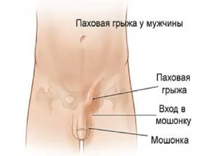 Болі в паху у чоловіків причини (праворуч, ліворуч) що це може бути і як лікувати (причини) Болі в паху у чоловіків причини (праворуч, ліворуч) що це може бути і як лікувати