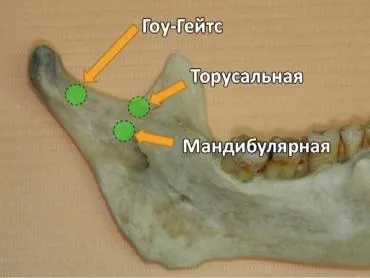 Торусальна анестезія техніка проведення, ускладнення (нижньощелепний валик торус) Торусальна анестезія техніка проведення, ускладнення