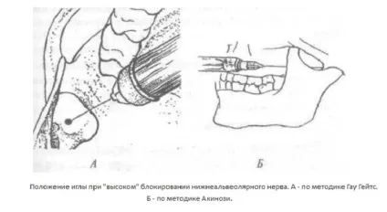 Торусальна анестезія техніка проведення по гоу-Гейтс, акінозі, Легарда і інші методи (торусальна анестезія техніка) Торусальна анестезія техніка проведення по гоу-Гейтс, акінозі, Легарда і інші методи