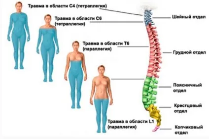 Травма спинного мозку, забій, струс і інші пошкодження ознаки, лікування і наслідки (спинного) Травма спинного мозку, забій, струс і інші пошкодження ознаки, лікування і наслідки