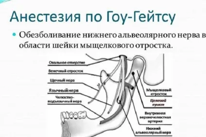 Торусальна анестезія техніка проведення по гоу-Гейтс, акінозі, Легарда і інші методи (торусальна анестезія) Торусальна анестезія техніка проведення по гоу-Гейтс, акінозі, Легарда і інші методи