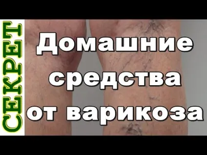Трави при варикозі якісь пити для лікування варикозного розширення вен (трави) Трави при варикозі які пити для лікування варикозного розширення вен