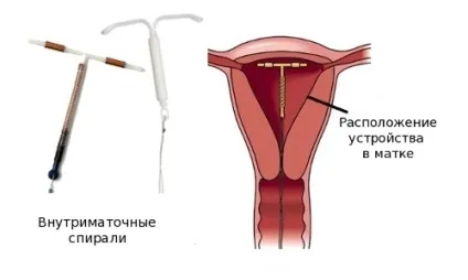Видалення внутрішньоматкової спіралі