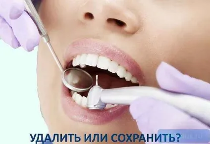 Видаляти або лікувати зуб (лікувати) Видаляти або лікувати зуб