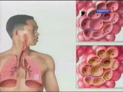 Забій легкого симптоми і лікування, наслідки 1 (легкого) Забій легкого симптоми і лікування, наслідки 1