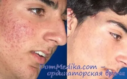 Догляд за шкірою після прищів