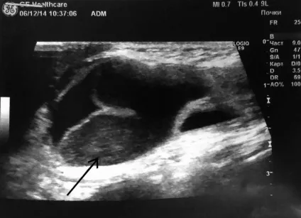 Узі патології органів травної системи (системи) Узі патології органів травної системи