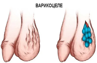 Варикоцеле у підлітків лікування без операції і причини виникнення варикозу яєчка в 14-16 років (варикоцеле) Варикоцеле у підлітків лікування без операції і причини виникнення варикозу яєчка в 14-16 років
