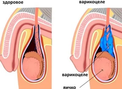 Варикоцеле у дітей та підлітків що це таке, причини виникнення, лікування в підлітковому (лікування) Варикоцеле у дітей та підлітків що це таке, причини виникнення, лікування в підлітковому