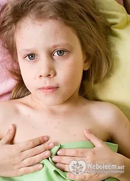 Вітрянка у дітей лікування (сучасне лікування вітрянки у дітей) Вітрянка у дітей лікування