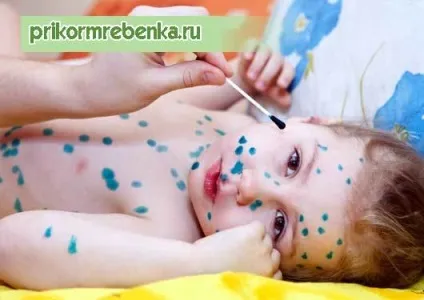 Вітрянка скільки днів потрібно мазати зеленкою дитини (днів) Вітрянка скільки днів потрібно мазати зеленкою дитини