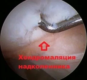 Вивих надколінка симптоми, лікування, операція (операція) Вивих надколінка симптоми, лікування, операція