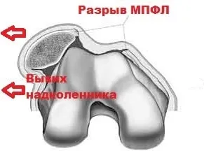 Вивих надколінка симптоми, лікування, операція (вивих) Вивих надколінка симптоми, лікування, операція