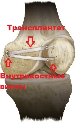 Вивих надколінка симптоми, лікування, операція (вивих надколінка звичний колінної чашечки лікування операція) Вивих надколінка симптоми, лікування, операція