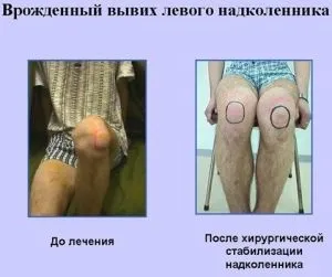 Вивих надколінка (звичний і постійно існуючий) симптоми, лікування, наслідки (надколінка) Вивих надколінка (звичний і постійно існуючий) симптоми, лікування, наслідки