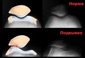 Вивих надколінка симптоми, лікування, операція (операція) Вивих надколінка симптоми, лікування, операція